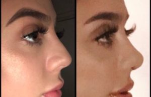 Washington DC Facelift Surgery Offers a Subtle Lift