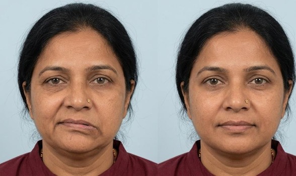 Facial Paralysis: Treatment Options and Recovery Possibilities